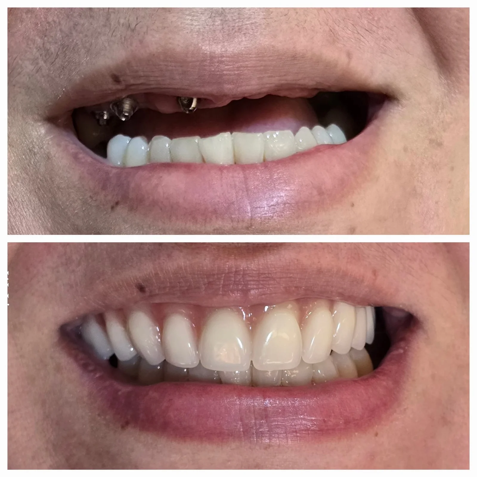 Antes e depois 1